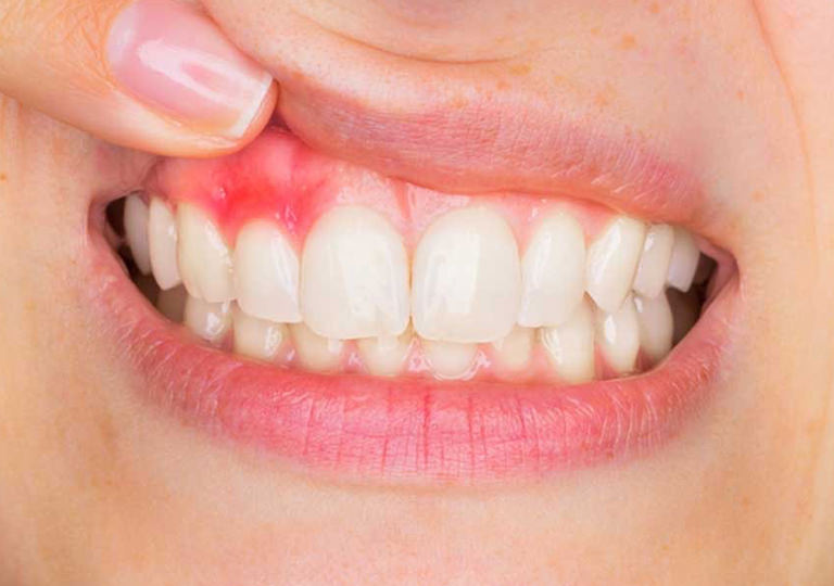 Gülüş Akademisi'nde diş eti tedavisi ve pembe estetik